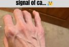 If your veins are visible in your hand, it is a signal of c… See more